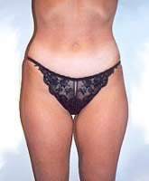 Liposculpture/Liposuction Patient 94726 Photo 1