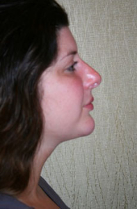 Chin Augmentation Patient 99366 Photo 4