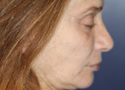 Eyelid Surgery Patient 29663 Photo 3