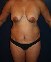 Tummy Tuck Patient 47655 Photo 3