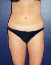 Liposculpture/Liposuction Patient 79741 Photo 8