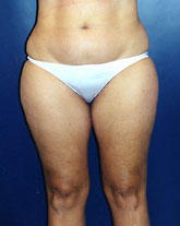 Liposculpture/Liposuction Patient 77135 Photo 3