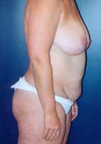 Liposuction Patient 89213 Photo 5