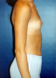 Breast Augmentation Patient 39964 Photo 3