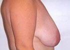 Breast Lift Patient 30639 Photo 1