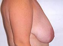 Breast Lift Patient 30639 Photo 1