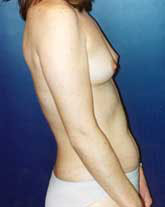 Breast Augmentation Patient 86978 Photo 5