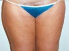 Liposculpture/Liposuction Patient 24791 Photo 2