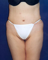 Tummy Tuck Patient 34643 Photo 2