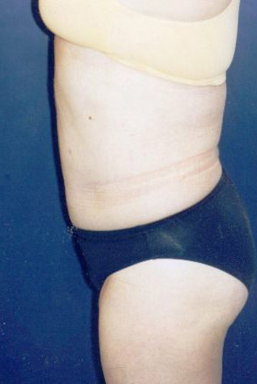 Tummy Tuck Patient 33040 Photo 8