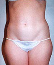 Liposculpture/Liposuction Patient 34954 Photo 1
