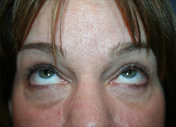 Eyelid Surgery Patient 23084 Photo 1