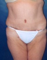 Tummy Tuck Patient 31720 Photo 6