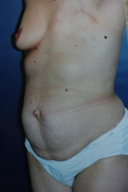 Breast Reconstruction Patient 85288 Photo 3