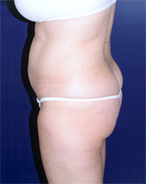 Liposculpture/Liposuction Patient 49367 Photo 1