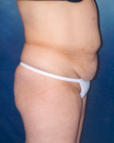 Tummy Tuck Patient 34643 Photo 5