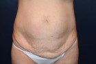 Tummy Tuck Patient 97420 Photo 1