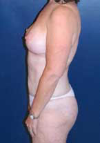 Liposuction Patient 89213 Photo 4