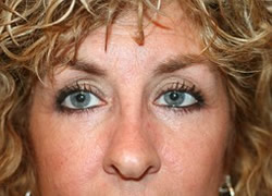 Brow Lift Patient 27228 Photo 2