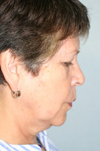 Necklift Patient 75449 Photo 1