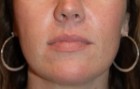 Facial Fillers Patient 40810 Photo 2