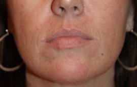 Facial Fillers Before and After