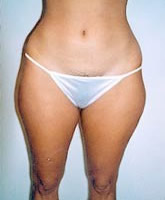 Liposuction Patient 91312 Photo 1