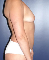 Liposculpture/Liposuction Patient 89673 Photo 3