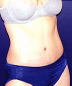 Tummy Tuck Patient 48333 Photo 4