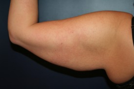 Arm Liposuction and Arm Brachioplasty Patient 40639 Photo 3