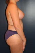 Breast Augmentation Patient 93076 Photo 2