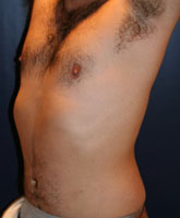 Male Liposuction Patient 48056 Photo 4