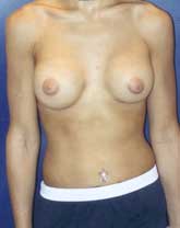Breast Augmentation Patient 60821 Photo 2