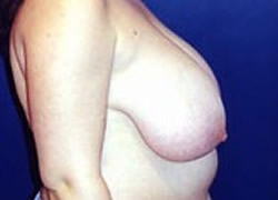 Breast Reduction Patient 55481 Photo 1