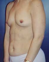 Breast Augmentation Patient 62551 Photo 1