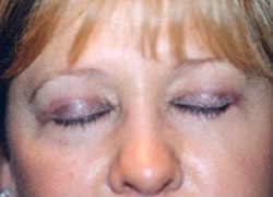 Eyelid Surgery Patient 43449 Photo 4