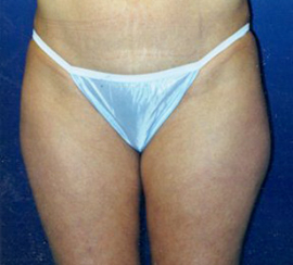 Liposculpture/Liposuction Patient 76341 Photo 3