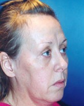 Facelift Patient 82930 Photo 3