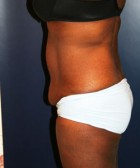 Tummy Tuck Patient 85564 Photo 1