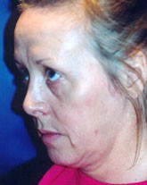 Chemical Peels Patient 57531 Photo 1