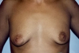 Breast Augmentation Patient 13426 Photo 1