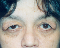 Eyelid Surgery Patient 17292 Photo 1