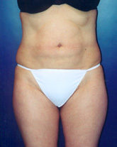 Tummy Tuck Patient 64354 Photo 1