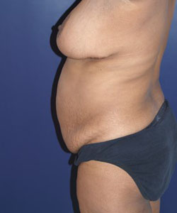 Tummy Tuck Patient 43610 Photo 3