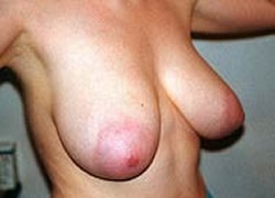 Breast Reduction Patient 14293 Photo 1