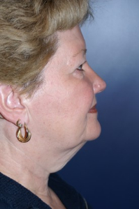 Facelift Patient 23902 Photo 1