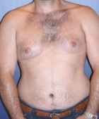 Male Liposuction Patient 48056 Photo 1