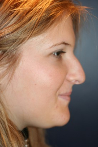 Rhinoplasty Patient 99231 Photo 1