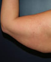 Arm Liposuction and Arm Brachioplasty Patient 15349 Photo 3