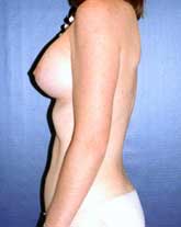 Breast Augmentation Patient 86978 Photo 4